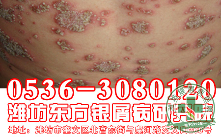银屑病患者的心理因素也会影响到发病?