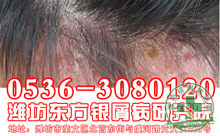 牛皮癣患者的护理工作怎样做 好