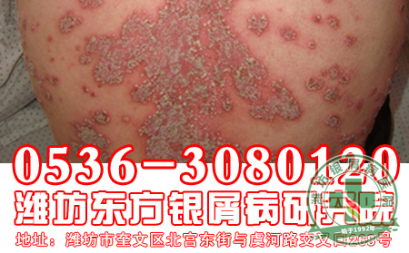 银屑病患者的护理工作要注意的问题有哪些？