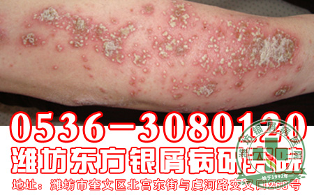 银屑病患者的食物要怎么进行合理食用？