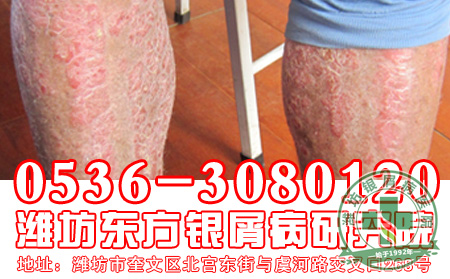 脓疱型银屑病是怎样分型的？