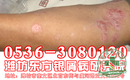 银屑病患者应该怎样对待偏方?