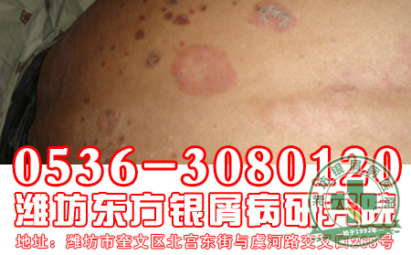 怎样调理银屑病患者的心理状态?