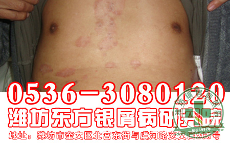 防止银屑病复发患者要怎么做？