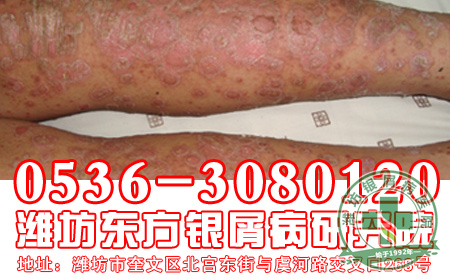 怎样做有助于减少银屑病久治不愈?
