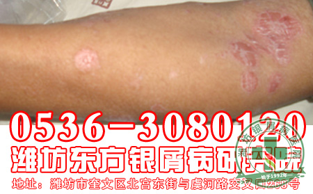 银屑病患者应该怎样注意治疗银屑病？