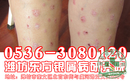 银屑病治疗忌用哪些药物?