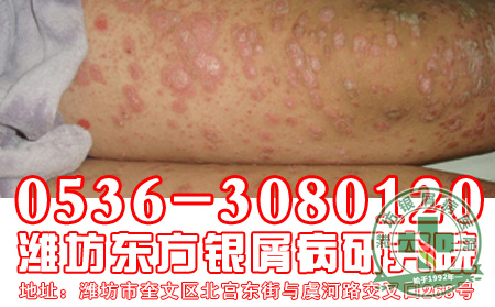 身心疾病的银屑病要怎样对待自己的心理?