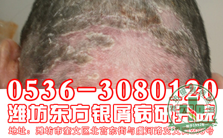 银屑病患者的治疗要注意什么问题?