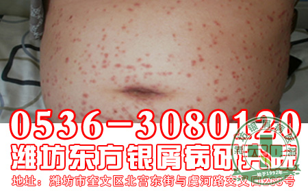 银屑病的治疗要避免陷入什么误区?