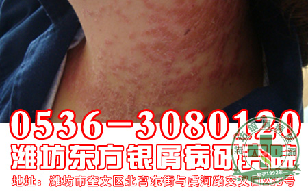 银屑病的治疗为什么要慎用偏方？