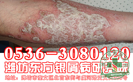 牛皮癣患者在选择治疗的时候要注意的问题有什