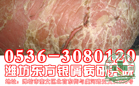牛皮癣患者的疾病治疗要注意的问题有什么?