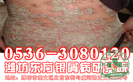 牛皮癣遗传
