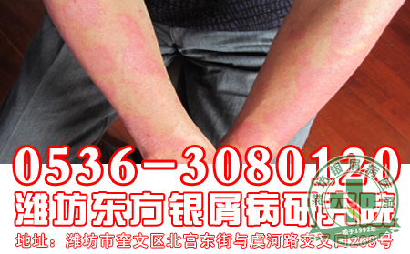 银屑病患者在锻炼的时候应该注意到什么