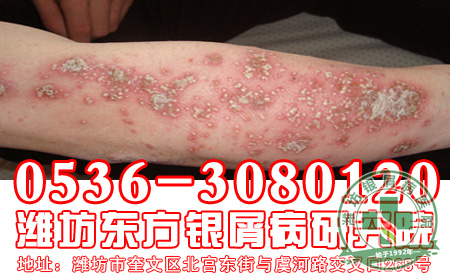 银屑病患者在治疗过程中注意做好哪些是非常重F9