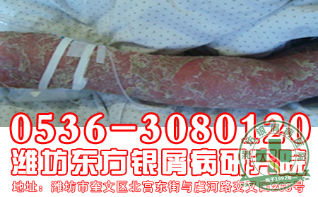 牛皮癣心理