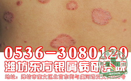 牛皮癣护理