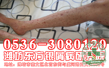 哪些原因会引发银屑病？预防银屑病你应该做大