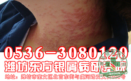 寻常型银屑病的发病后患者要注意什么