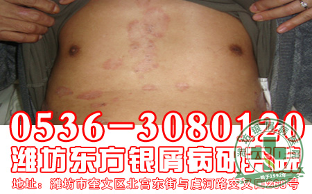 银屑病的护理工作患者应该注意怎样做R