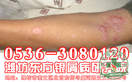 牛皮癣治疗