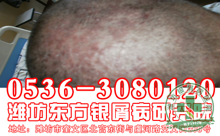 银屑病的日常治疗工作应该怎样做