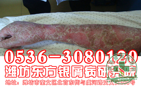 银屑病有哪些发病后的危害5