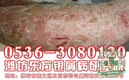 牛皮癣治疗