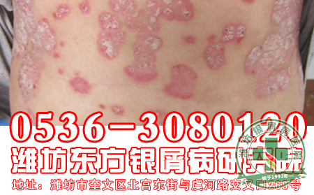 临床上的屈侧银屑病患者应该注意什么?