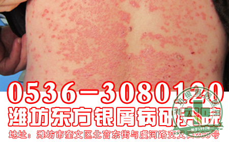 银屑病患者在日常生活中要注意哪些事情？