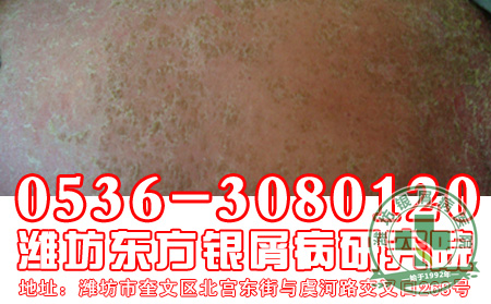 银屑病患者的心理问题要注意什么?