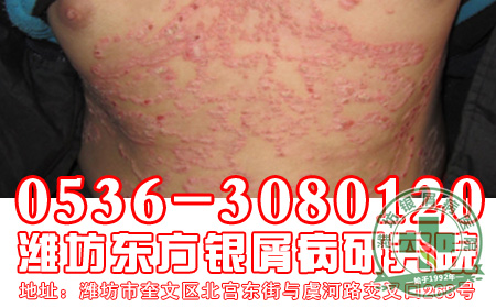 银屑病患者使用药物要注意什么问题?