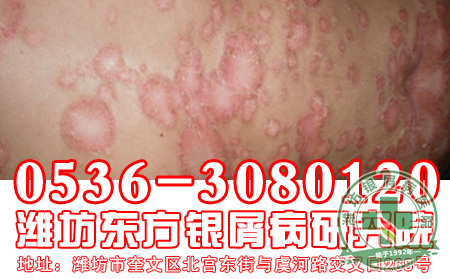 对于银屑病患者应该知道什么？