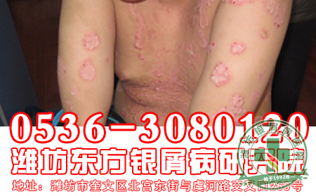 银屑病患者怎样做有助于减少皮损加重？