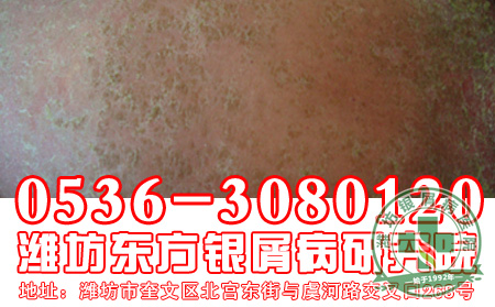 患者应该知道哪些银屑病发病症状?