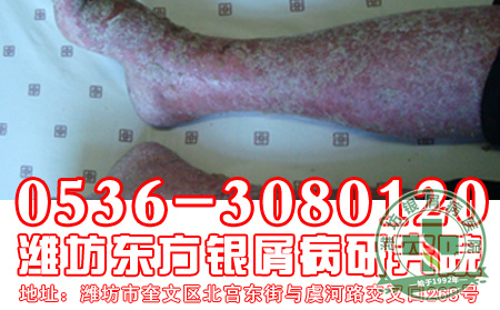 怎样做有助于帮助患者治疗银屑病？