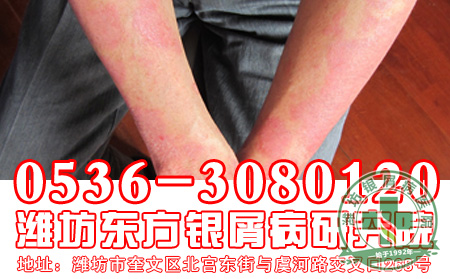 银屑病患者为什么要注意辨别银屑病的初期症状