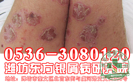 银屑病发病会表现出哪些特征表现？