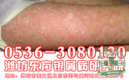 对于银屑病护理患者应该做好哪些?