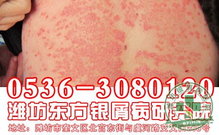 你知道银屑病应该怎样治疗 好吗？