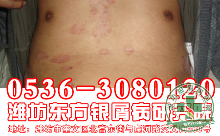 银屑病患者怎样做好银屑病的心理工作?
