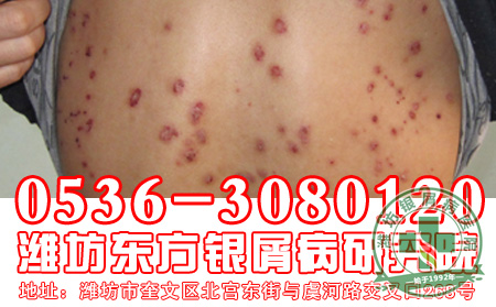 银屑病的发病有什么特征性的表现出现？