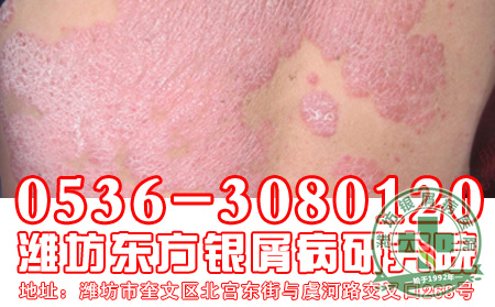 减少银屑病的出现和复发,患者应该注意做好哪