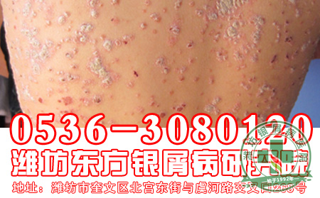 银屑病的保健防护怎样做比较好？