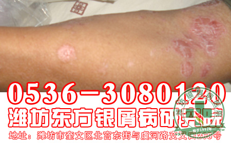 银屑病治疗为什么要注意心理的相关因素?