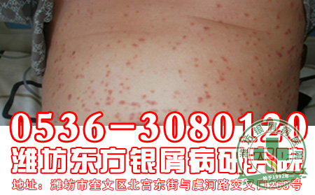 银屑病护理