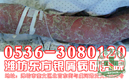 银屑病护理应该做到哪些？