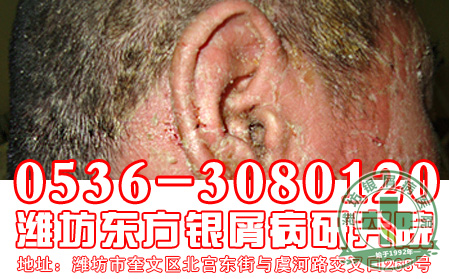 银屑病用药要注意什么？