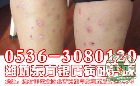 银屑病患者的日常护理工作要注意什么